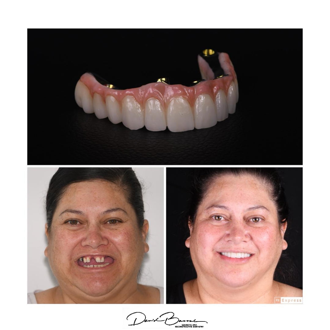Teeth on Implants - Before and After